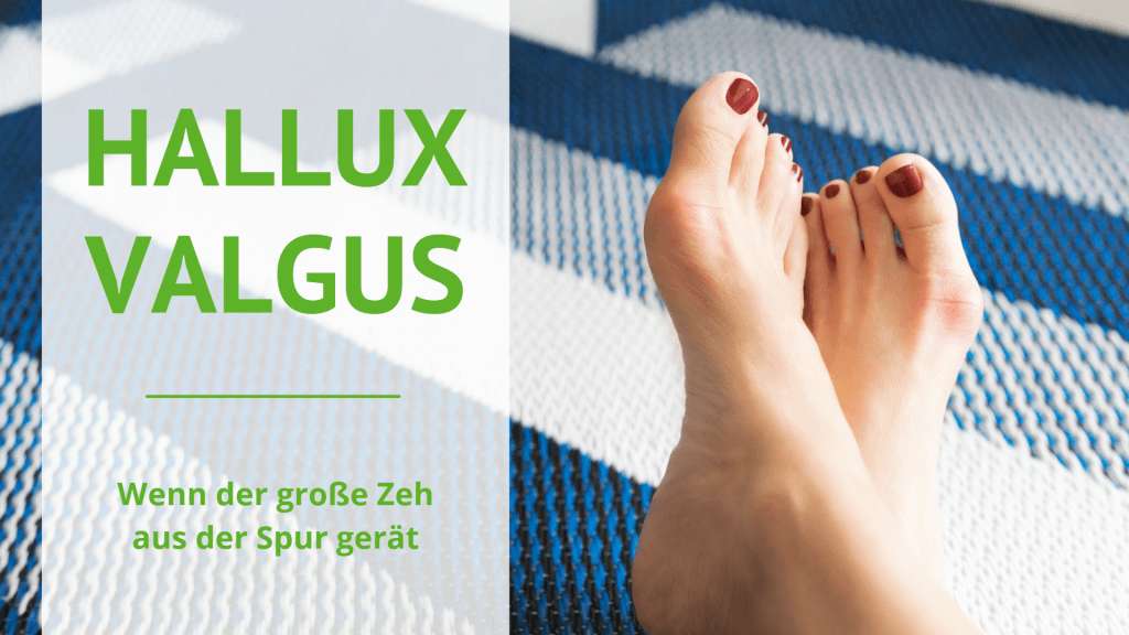 Hallux valgus - Wenn der große Zeh aus der Spur gerät